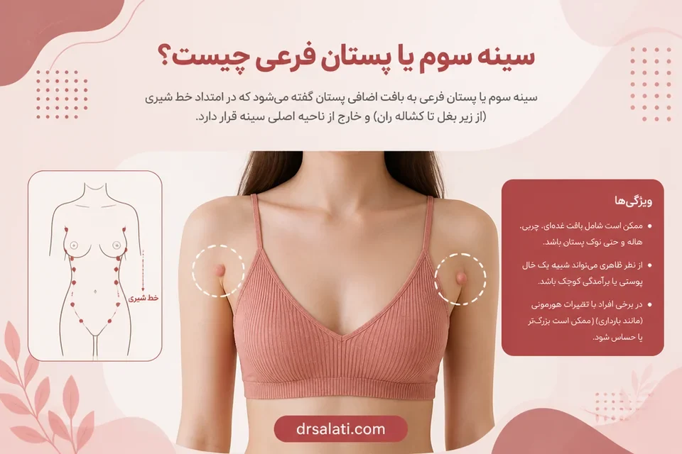 سینه سوم یا پستان فرعی چیست؟